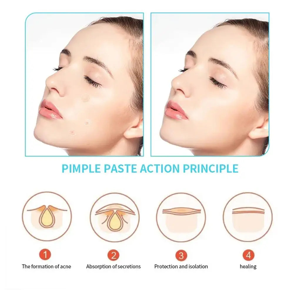 Glaze & Gloss Invisible Acne & Pimple Repair Patches (30-Pack)